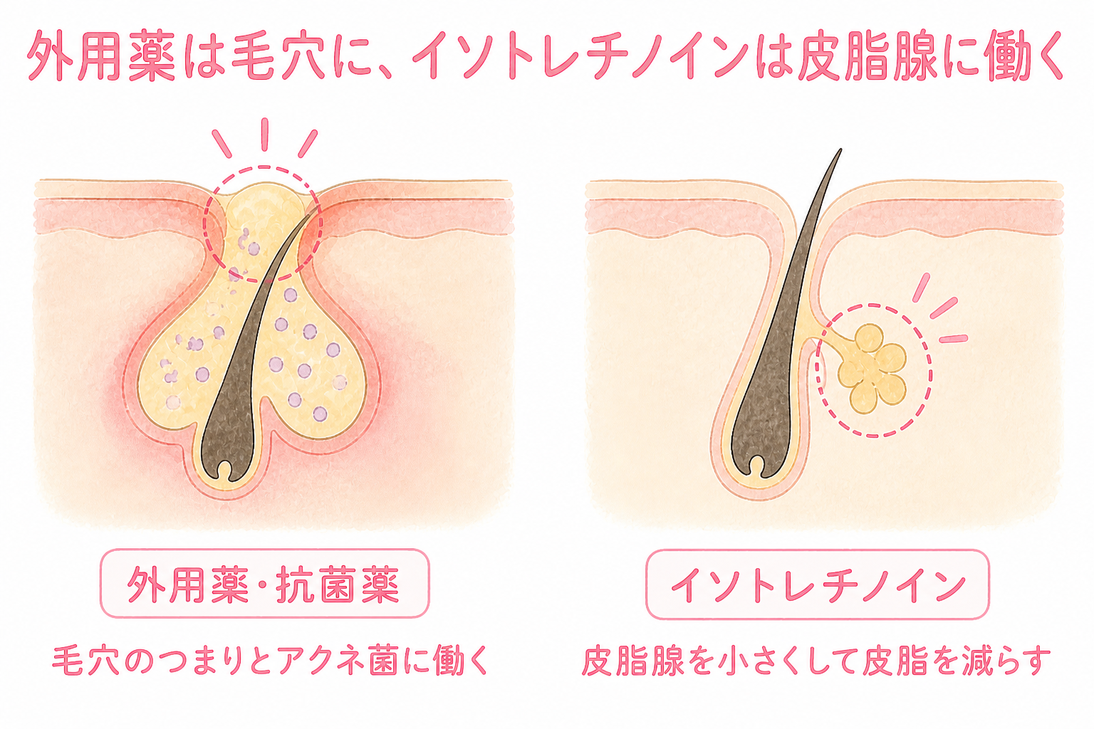 外用薬は毛穴のつまりとアクネ菌に働き、イソトレチノインは皮脂腺を小さくして皮脂を減らす